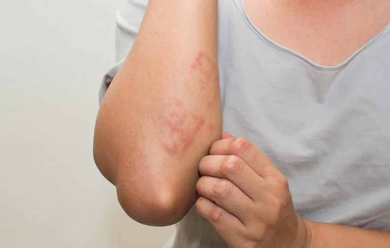 Eczema: Síntomas, causas y tratamiento