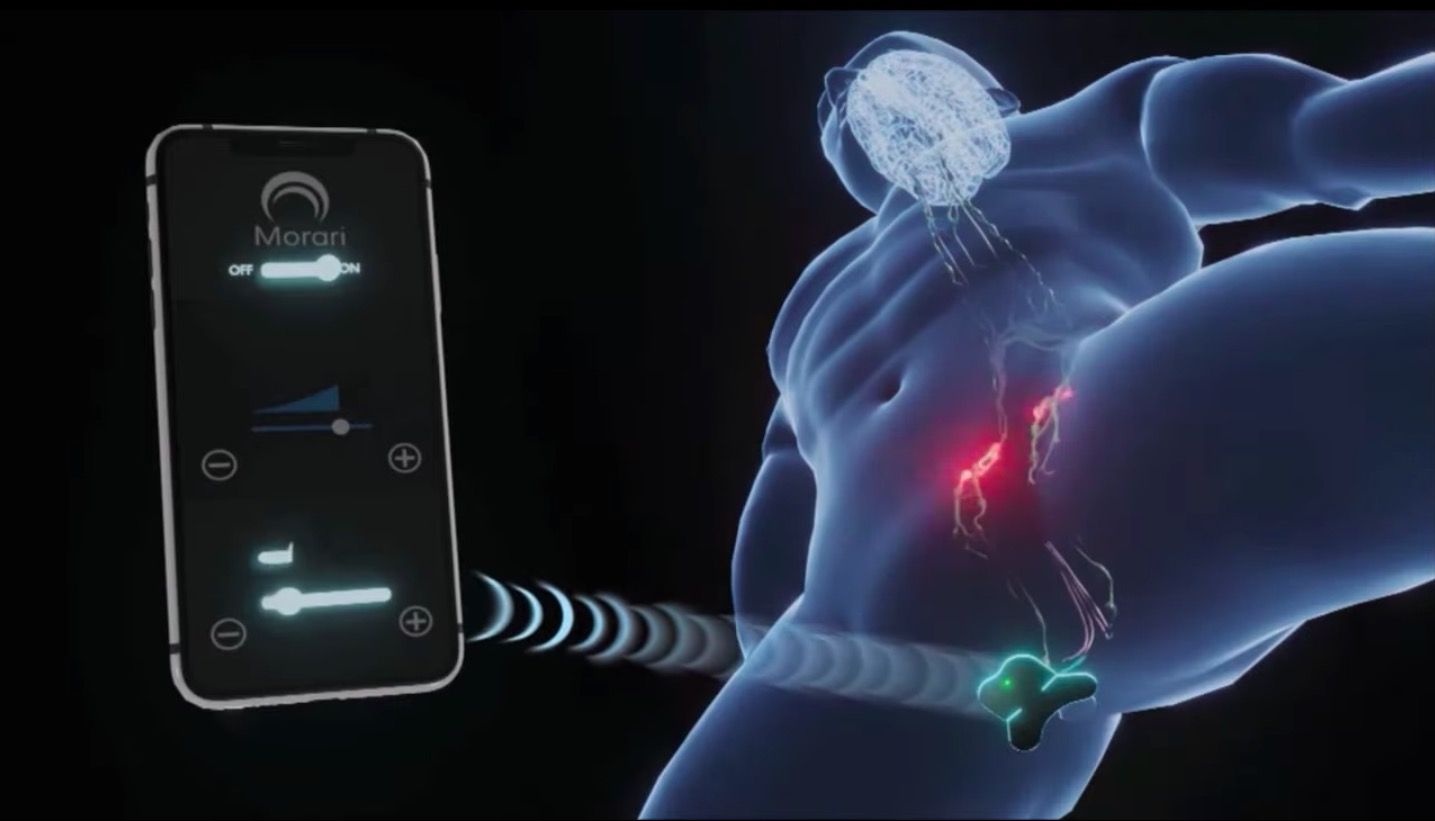 ¿Puede este dispositivo portátil prevenir realmente la eyaculación precoz?