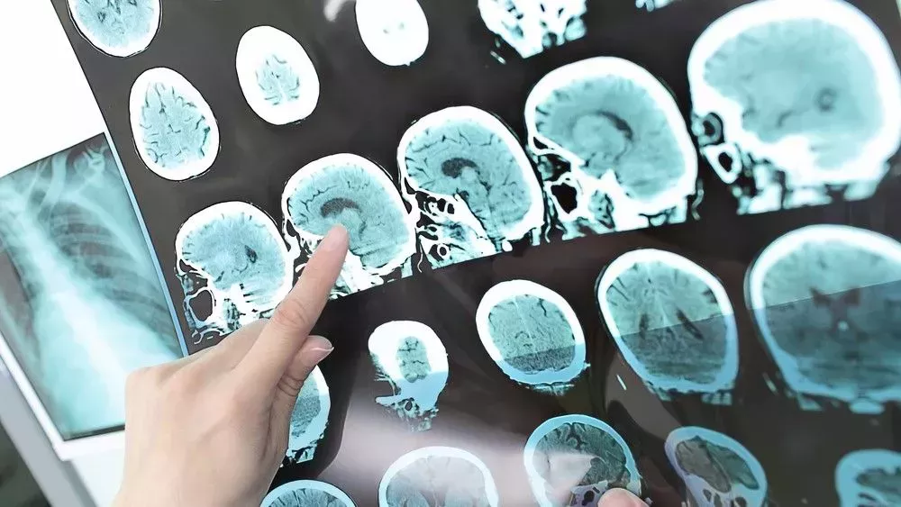El primer escáner de un cerebro humano moribundo revela que la vida puede