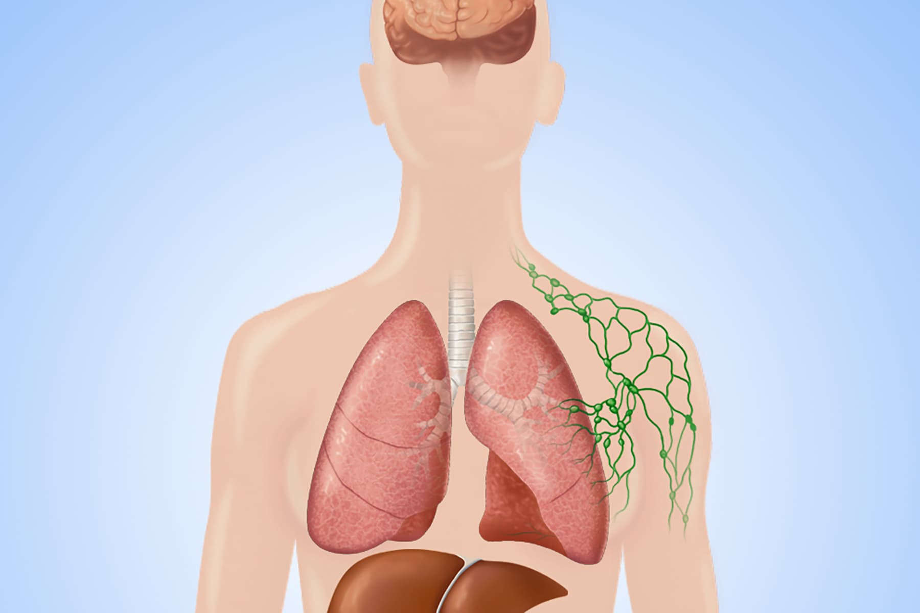 Dónde se propaga el cáncer de mama