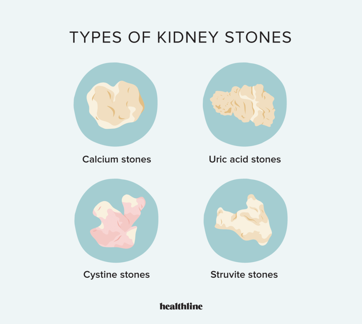 kidney stones, types of kidney stones chart