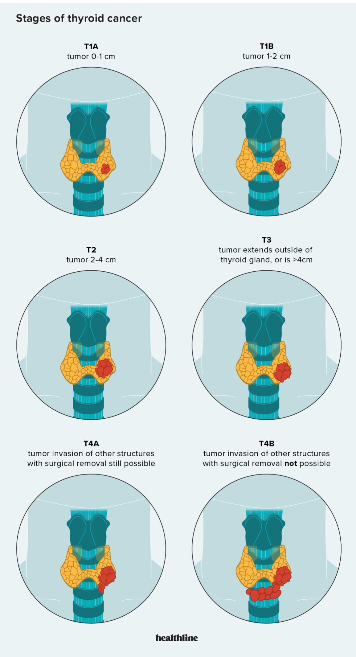 Illustration depicting the stages of thyroid cancer