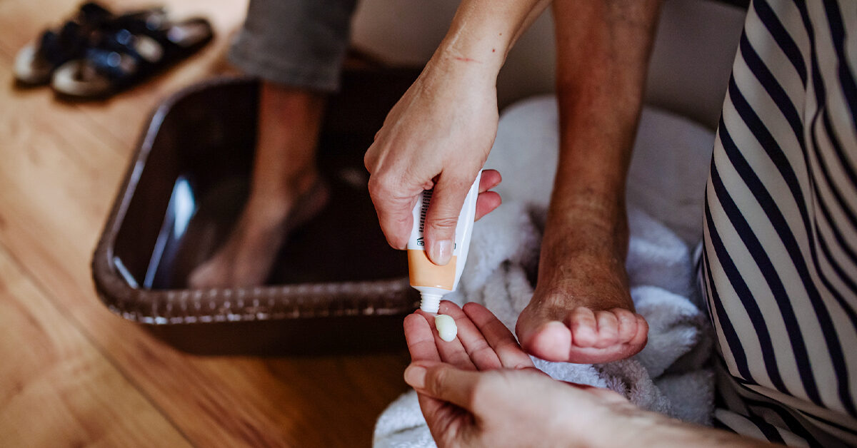 Opciones de tratamiento para la psoriasis ungueal