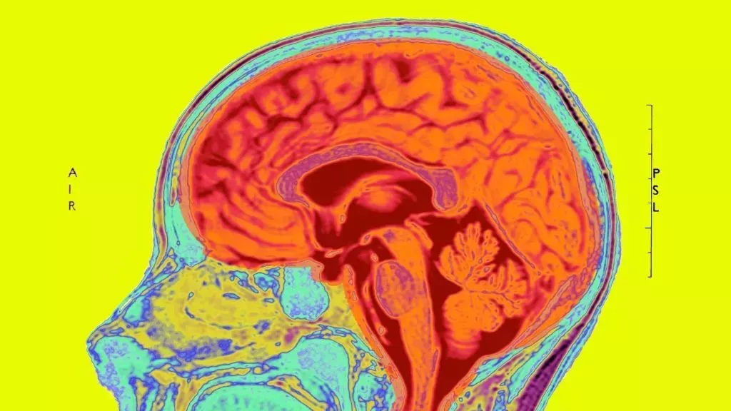 Un nuevo fármaco contra el Alzheimer ralentiza ligeramente el deterioro cognitivo. Los expertos dicen que no es una bala de plata.