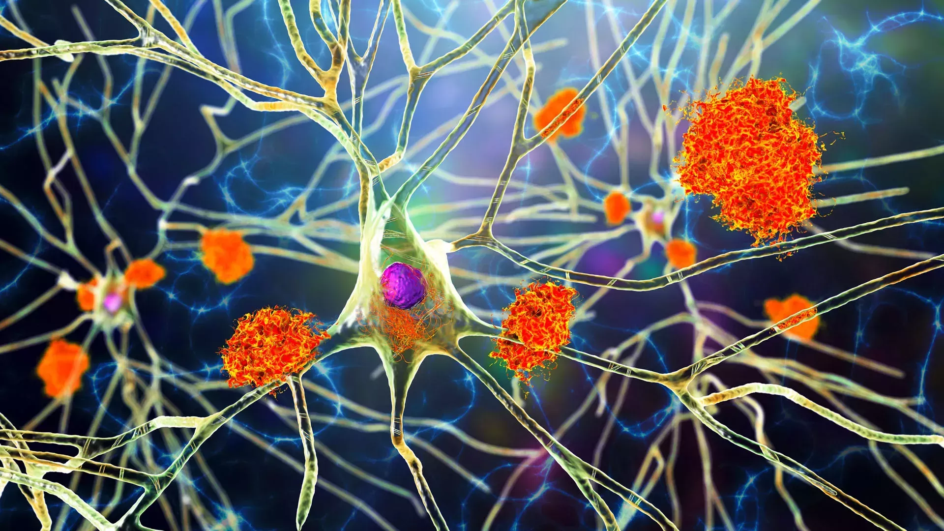 Es probable que el entrenamiento cerebral no reduzca el riesgo de Alzheimer.