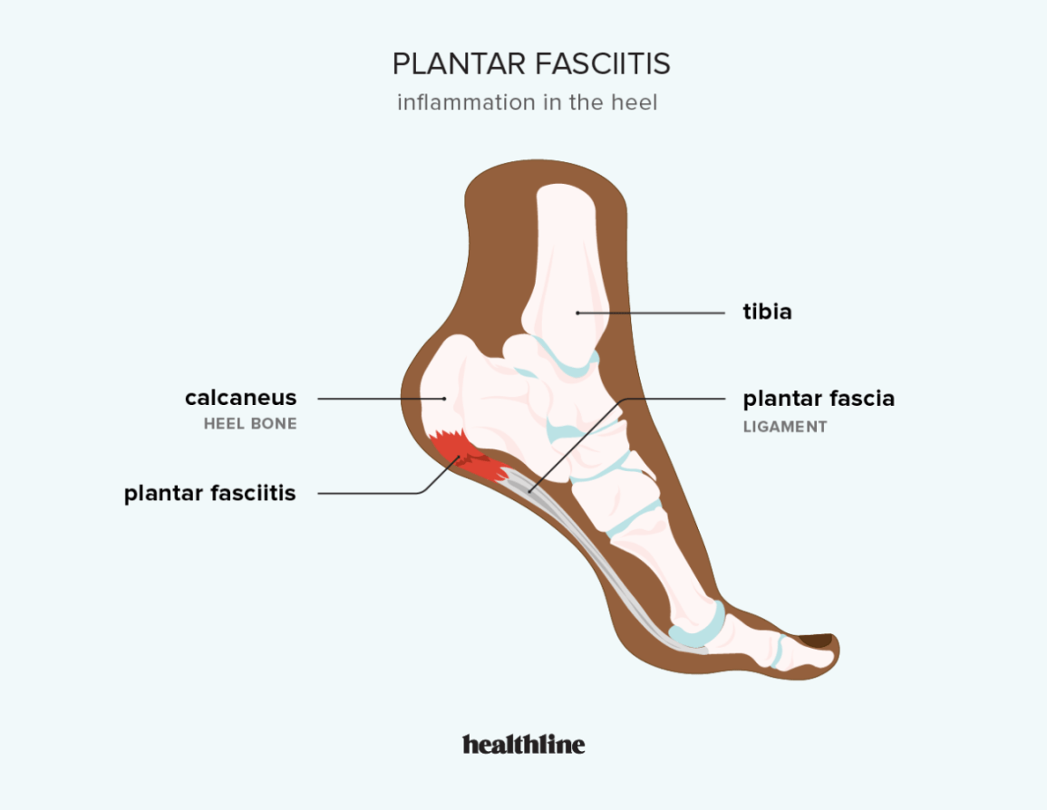 Illustration of where on the heel plantar fasciitis occurs