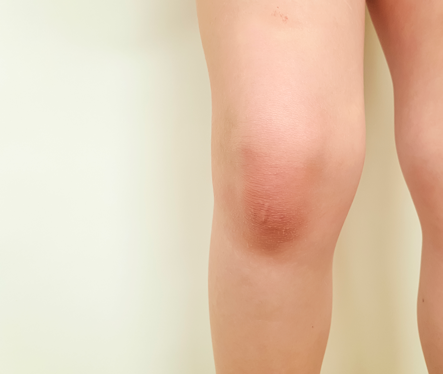 La verdadera razón por la que se te hincha la rodilla, según los médicos