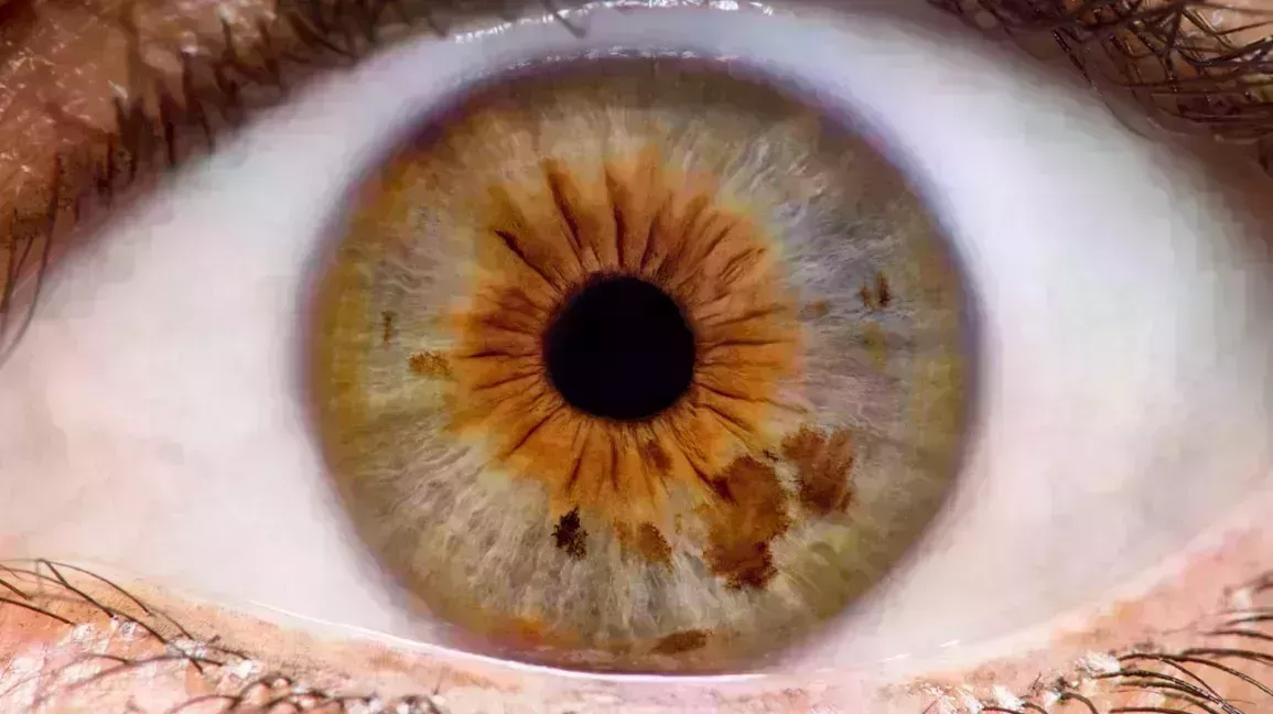 brown spot on white of eye