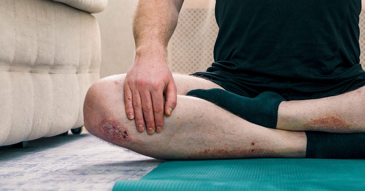 Psoriasis y enfermedad hepática
