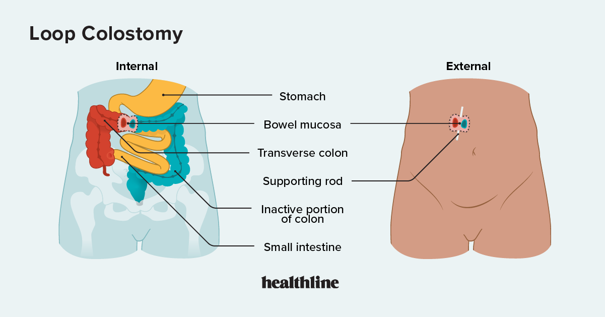 ¿Qué es una colostomía en asa?