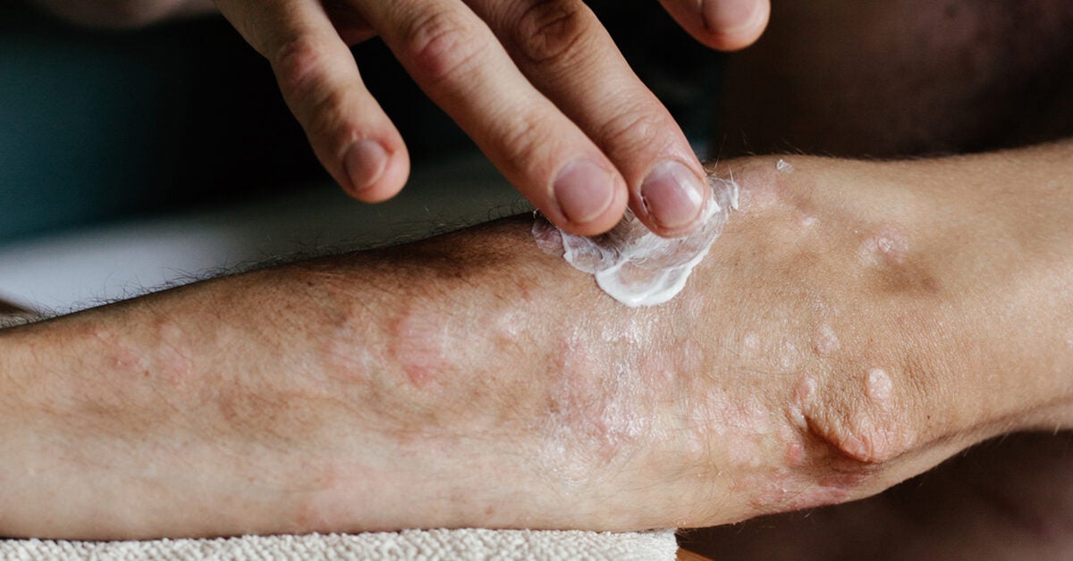 Respuestas a sus preguntas más frecuentes: Psoriasis y otras enfermedades crónicas