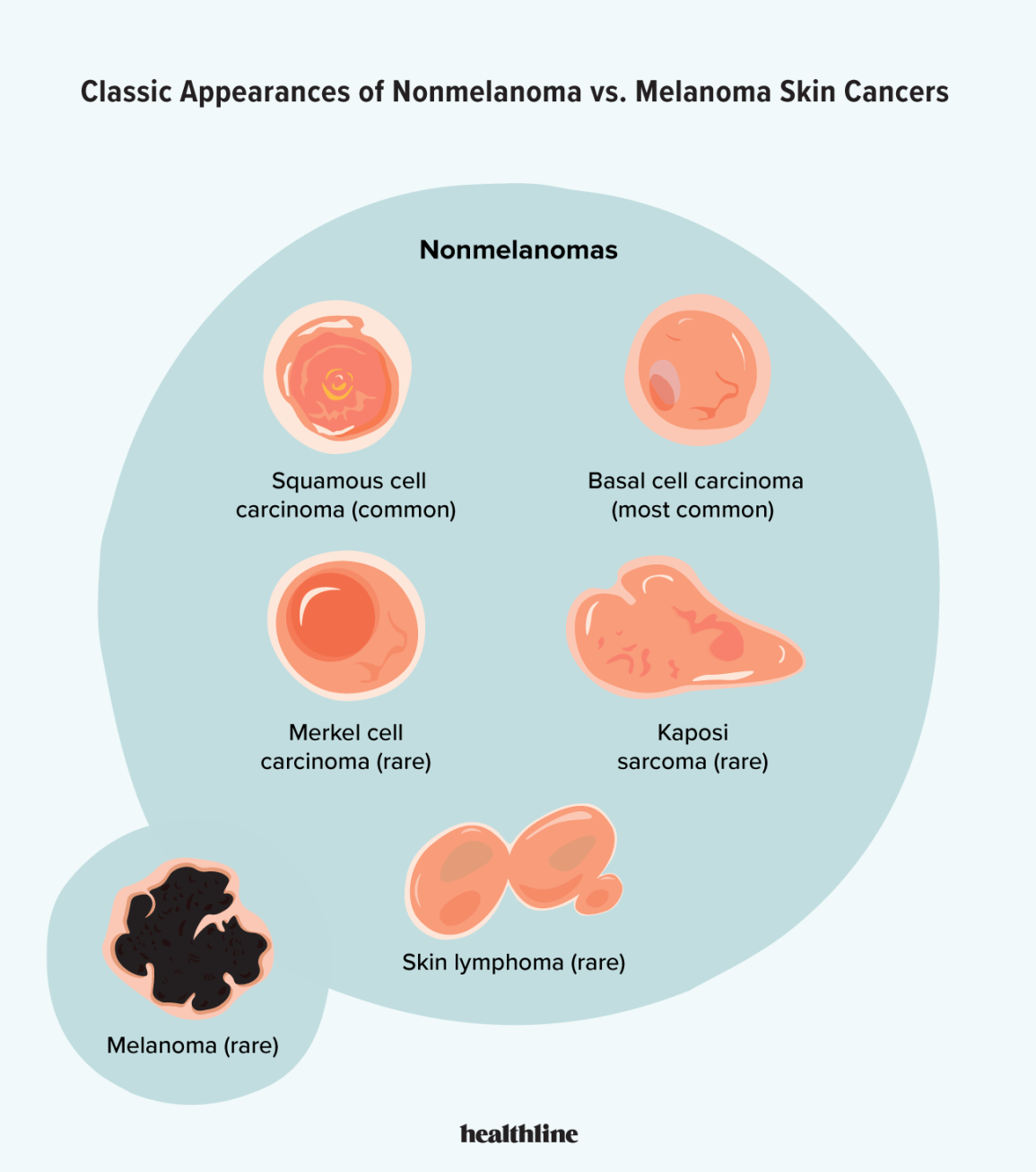 how different skin cancer types tend to appear