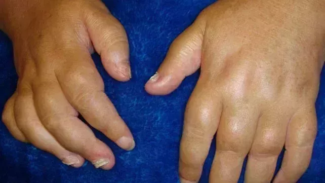 Psoriatic arthritis