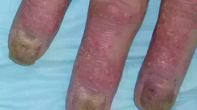 Psoriatic arthritis