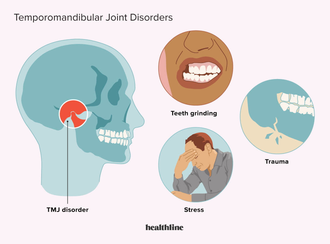 Conditions that may cause TMJ, such as teeth grinding and stress