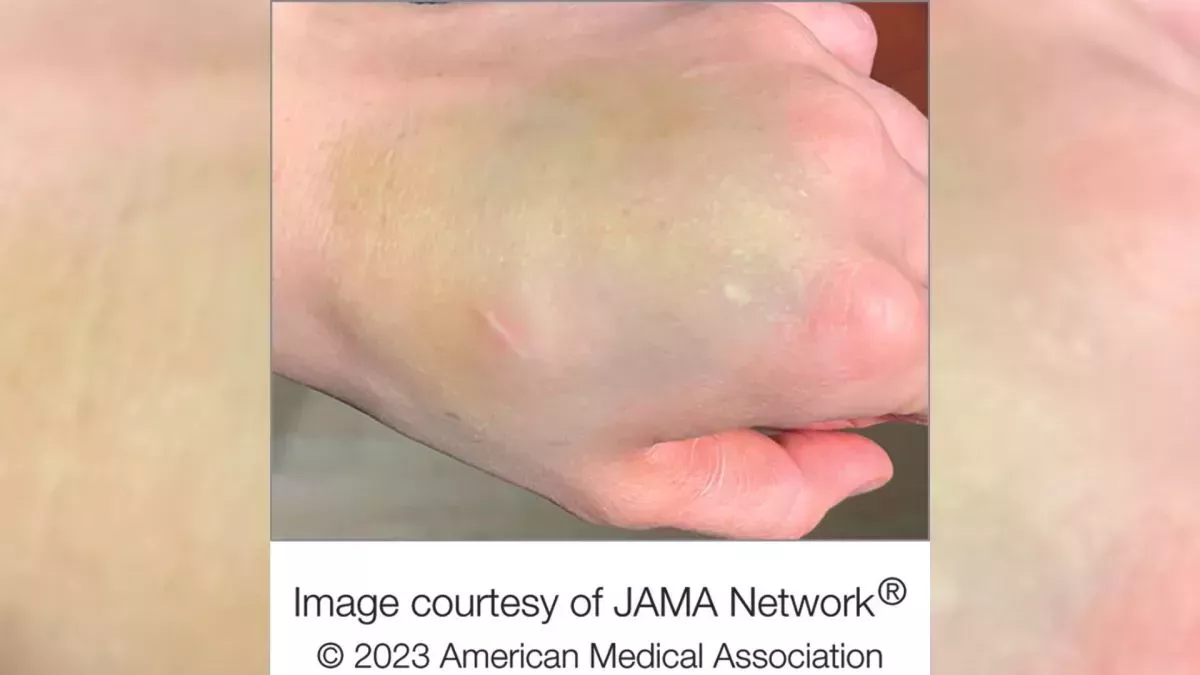 Un extraño hematoma verde en la mano de una mujer resulta ser un raro tumor