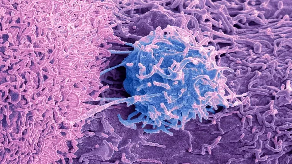 Los tratamientos del cáncer de próstata pueden evitarse o retrasarse en muchos casos, según un gran estudio