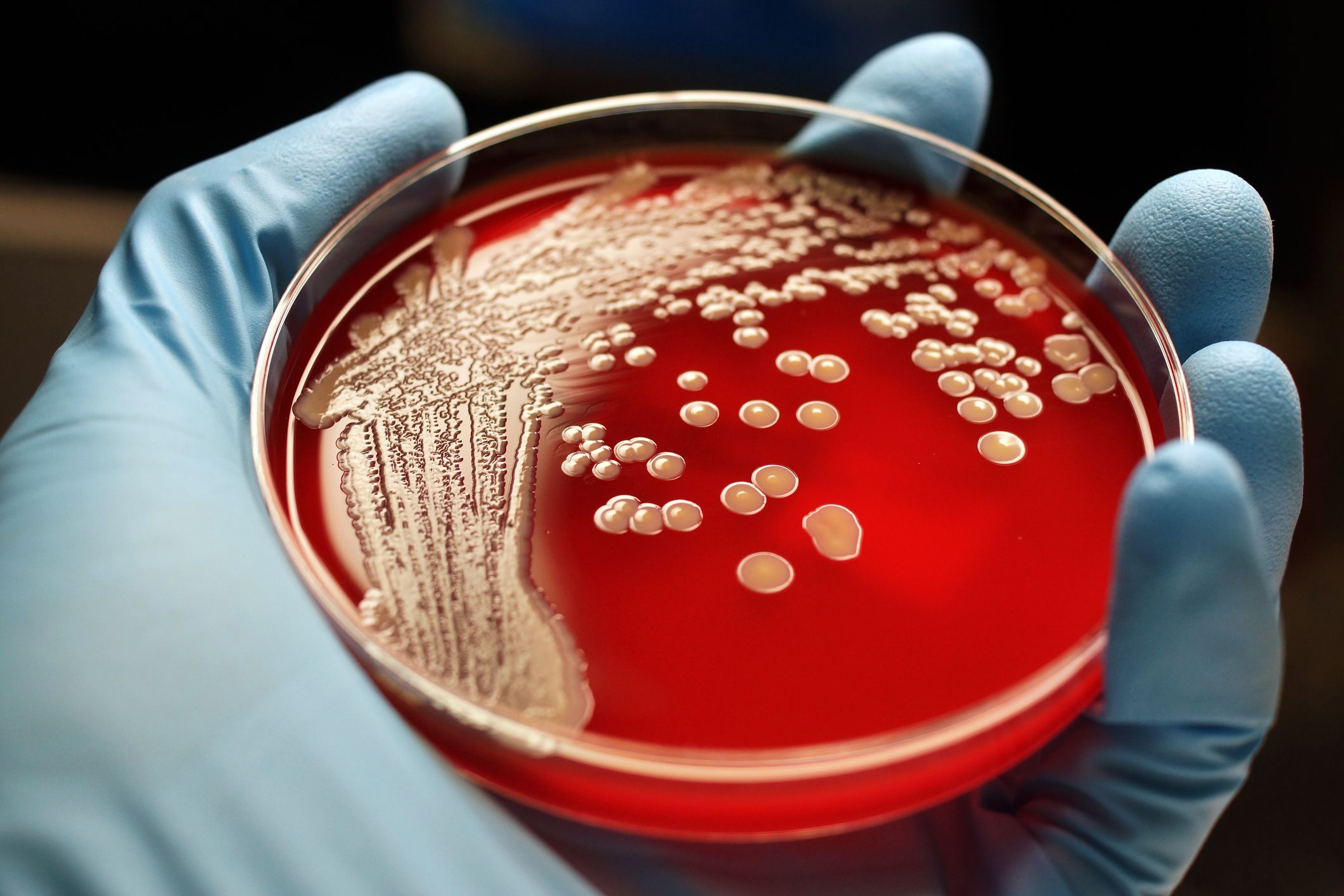 Todo lo que debe saber sobre las infecciones por estafilococo