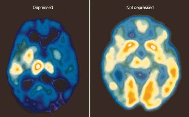 Una dieta rica en proteínas reduce los síntomas de la depresión, según un nuevo estudio