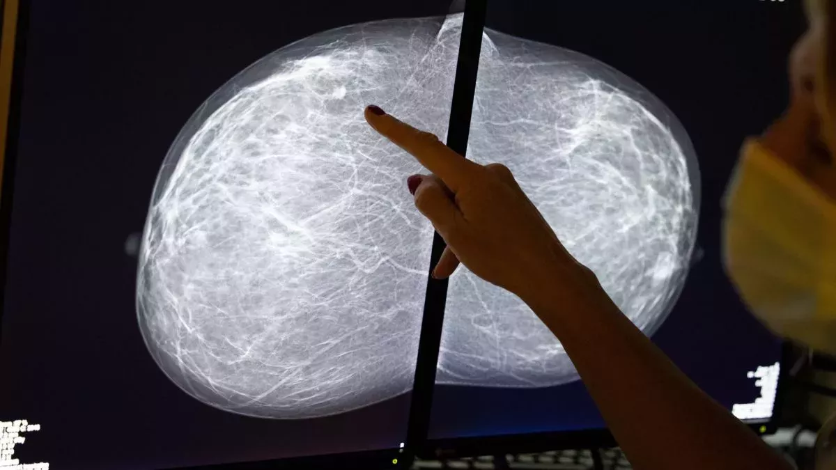 Las pacientes negras pueden necesitar pruebas de detección del cáncer de mama antes de lo que recomiendan muchas directrices