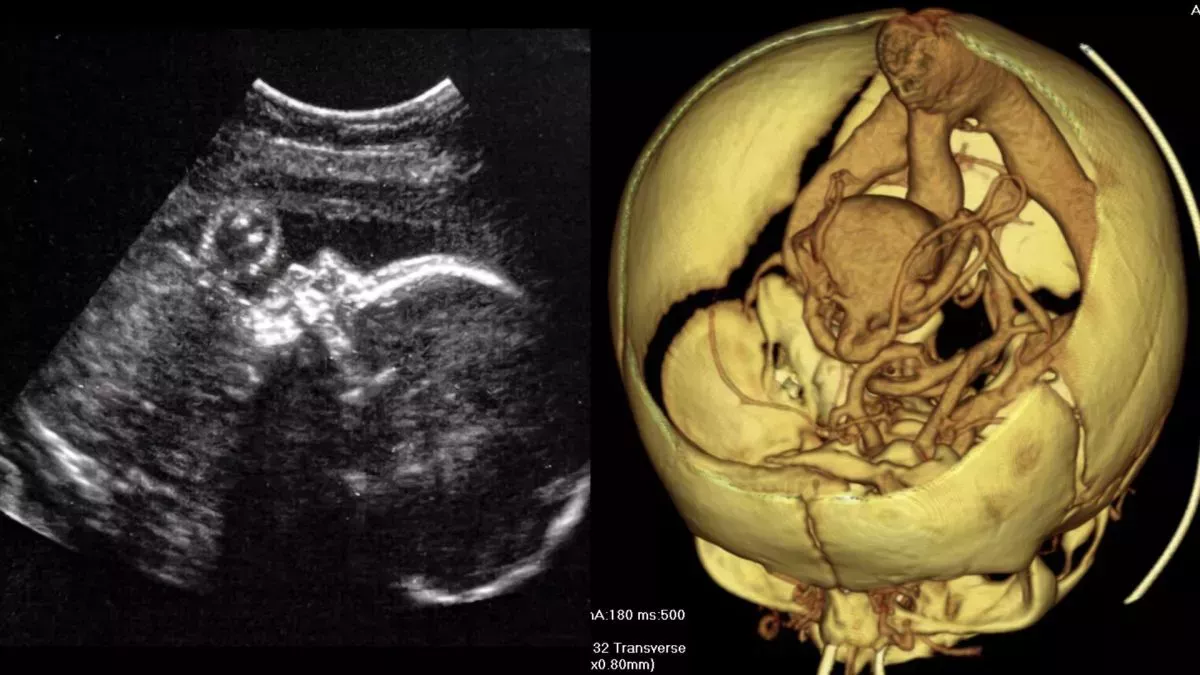 Los médicos realizan la primera operación cerebral de su clase a un feto en el útero