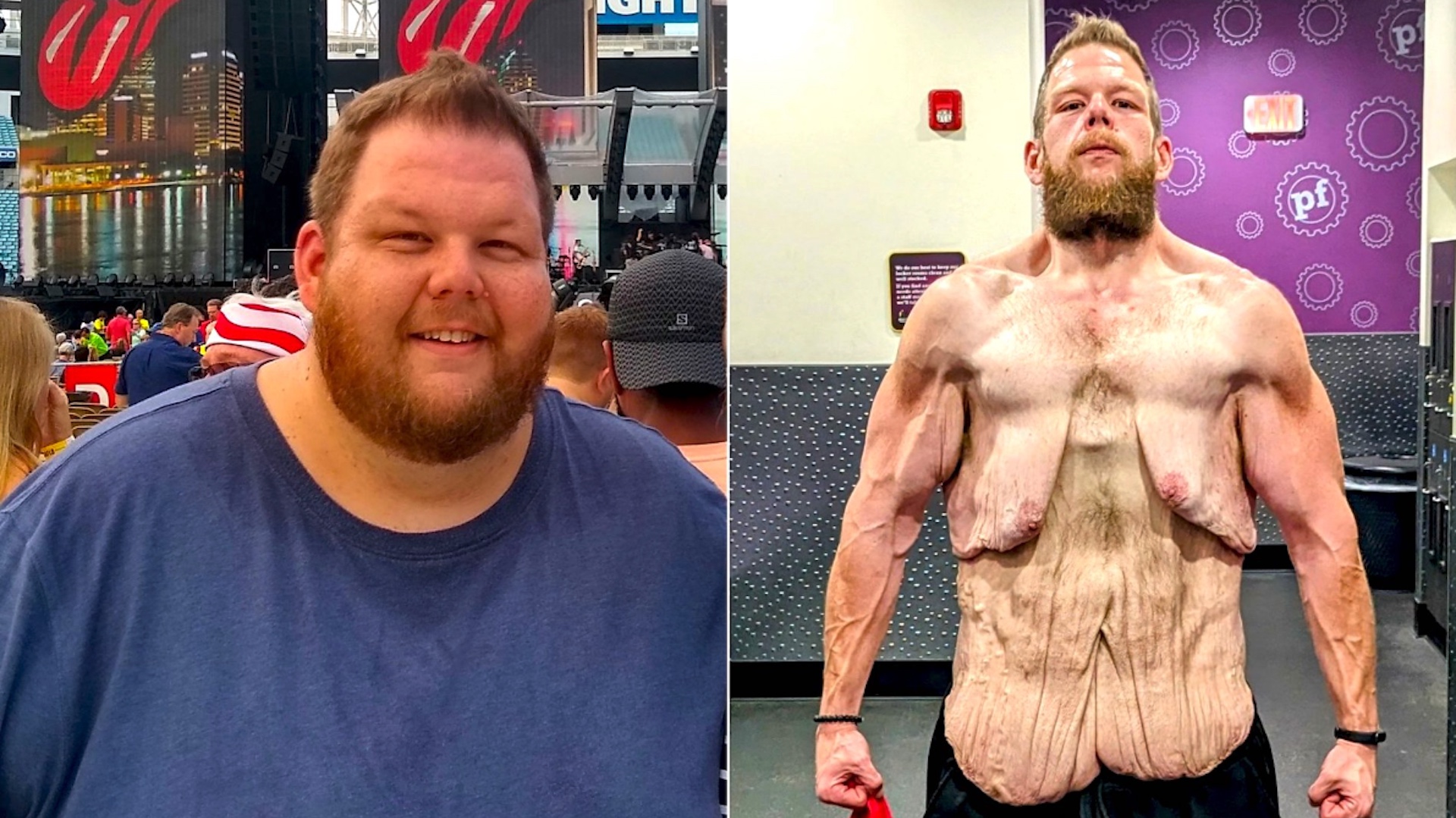 Un hombre que perdió 160 kg en una asombrosa transformación corporal revela un inesperado efecto secundario