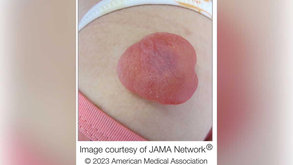 Un extraño tumor rojo en el brazo de una niña rezumaba "sustancia gelatinosa" al reventarlo