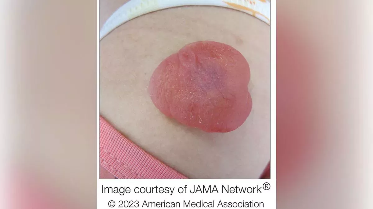 Un extraño tumor rojo en el brazo de una niña rezumaba 