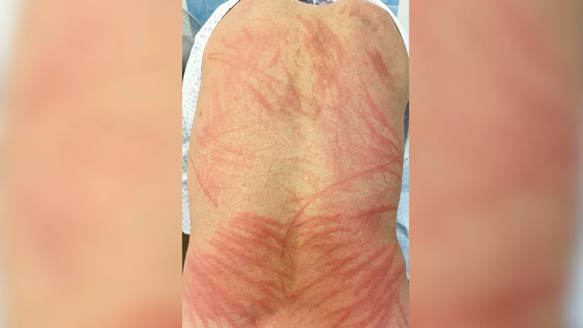 Un hombre sufre una rara