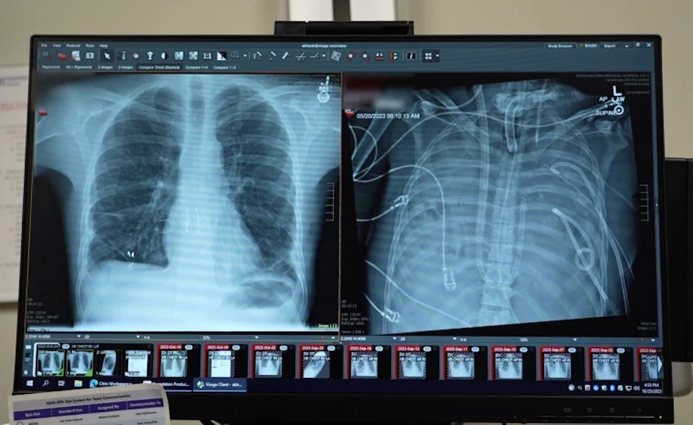 Unos implantes de silicona salvan a un vapeador en estado crítico de una infección pulmonar mortal