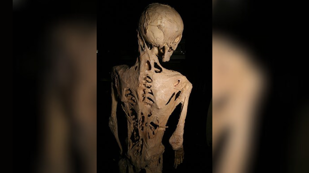 Una rara condici贸n que causa que una persona crezca un segundo esqueleto