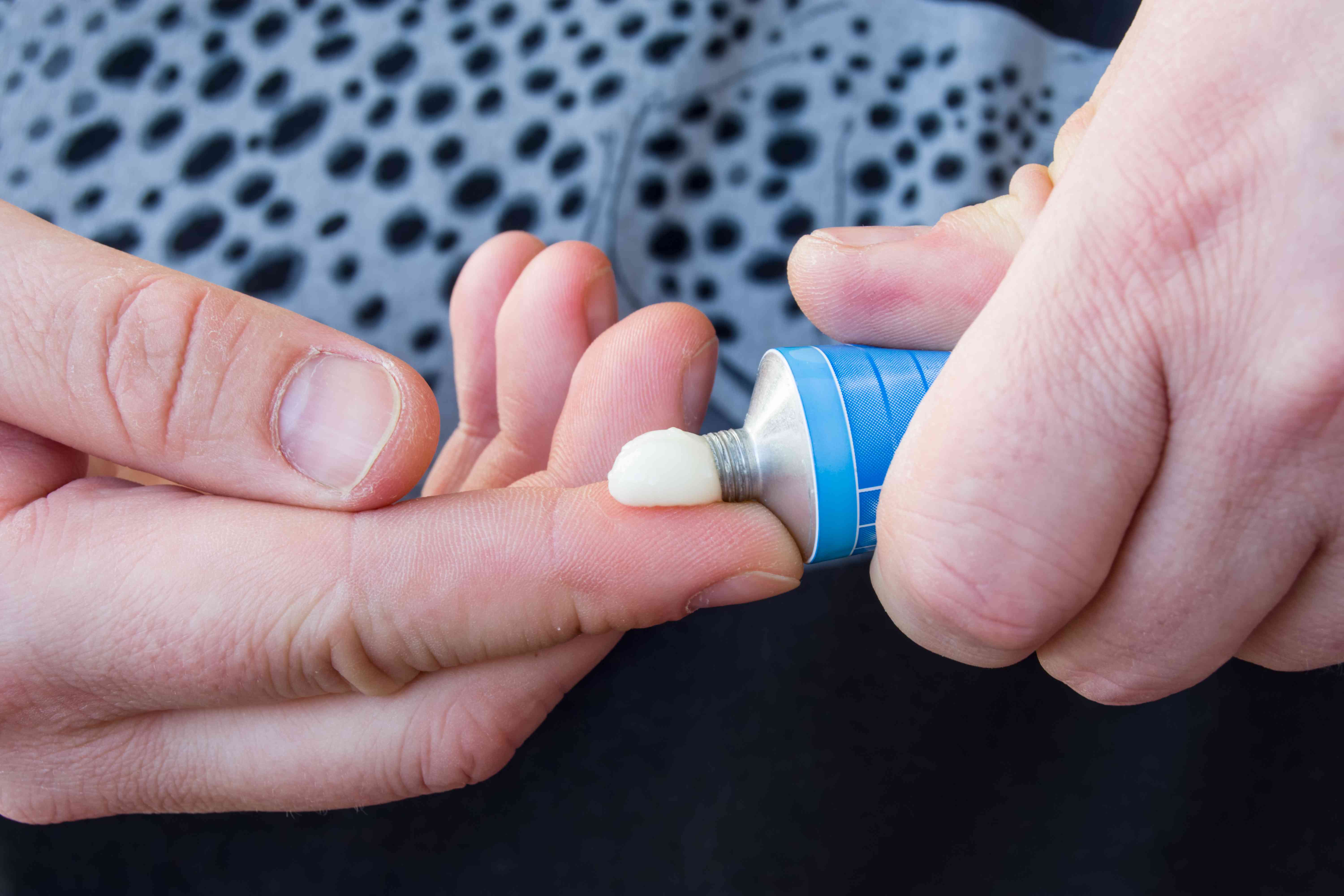 Más productos para el acné retirados por un químico que causa cáncer—Consulta la lista completa aquí