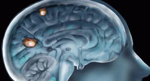 Puedes tener parásitos en el cerebro y no lo sabes