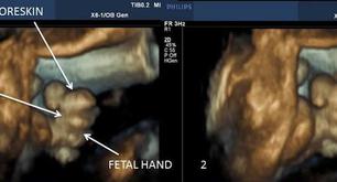 Imágenes demuestran que el feto se masturba dentro de su madre