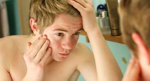 Haber sufrido acné en la adolescencia hará que envejezcas más tarde